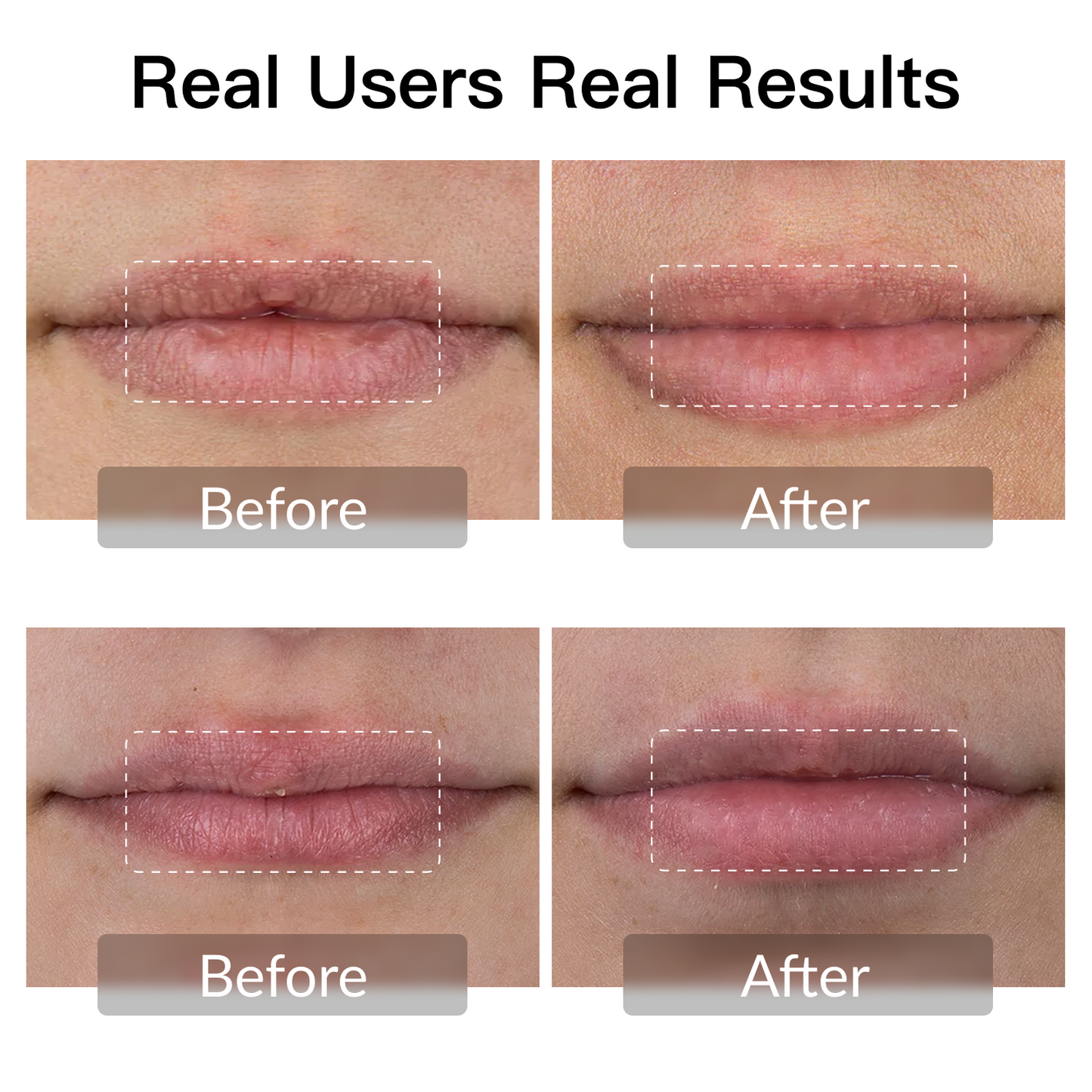 Swirise LED Light Therapy Device for Lip
