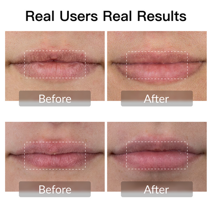 Swirise LED Light Therapy Device for Lip