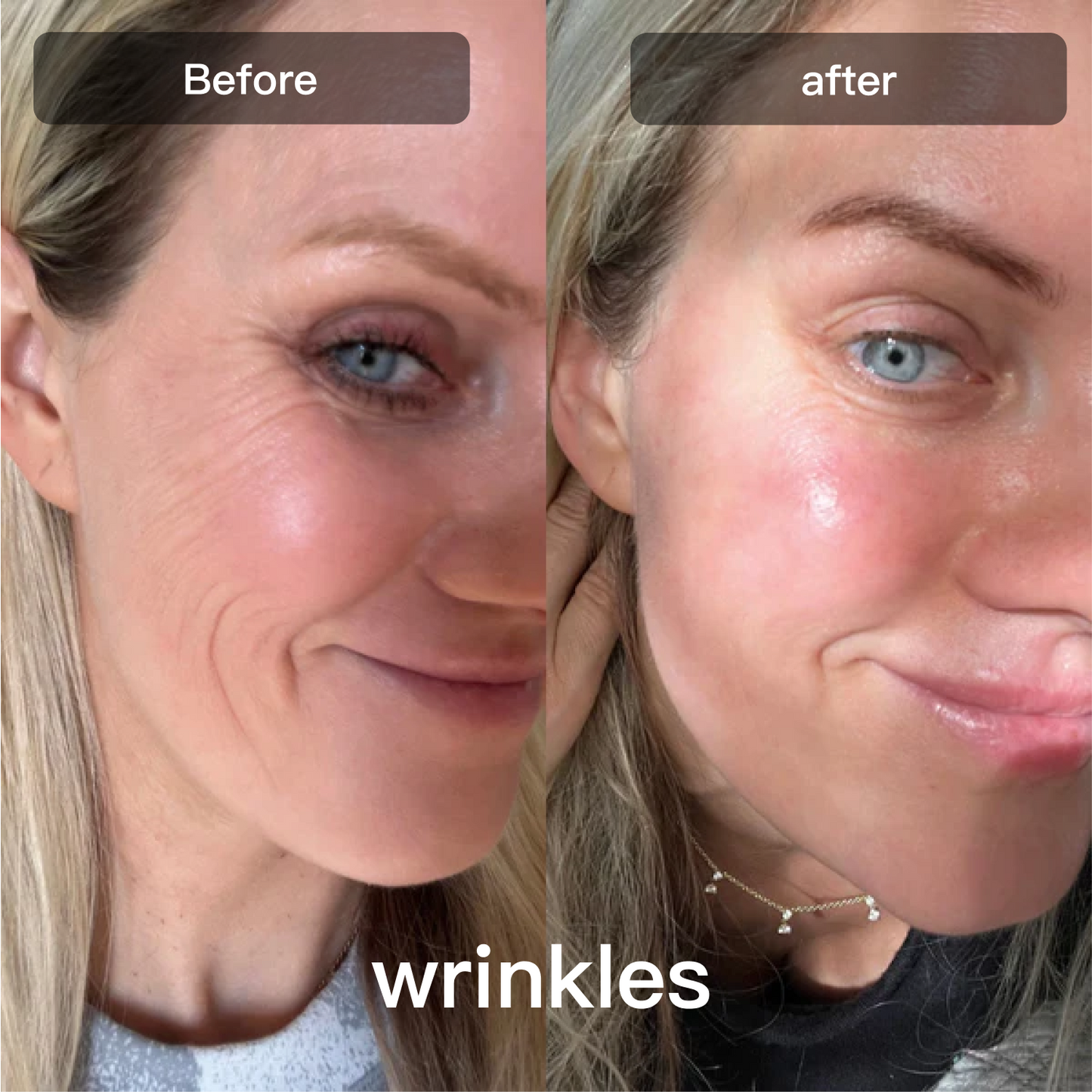 Swirise LED Light Therapy Device